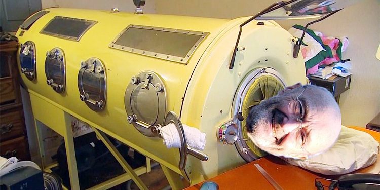 ৭০ বছর ধরে ‘লোহার ফুসফুস’র ভেতরে বেঁচে আছেন পল আলেকজান্ডার