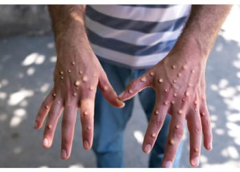 এমপক্স ভাইরাস নিয়ে স্বাস্থ্য অধিদপ্তরের বিশেষ সতর্কতা, হটলাইন চালু