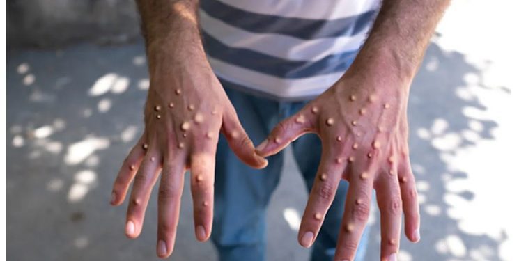 এমপক্স ভাইরাস নিয়ে স্বাস্থ্য অধিদপ্তরের বিশেষ সতর্কতা, হটলাইন চালু